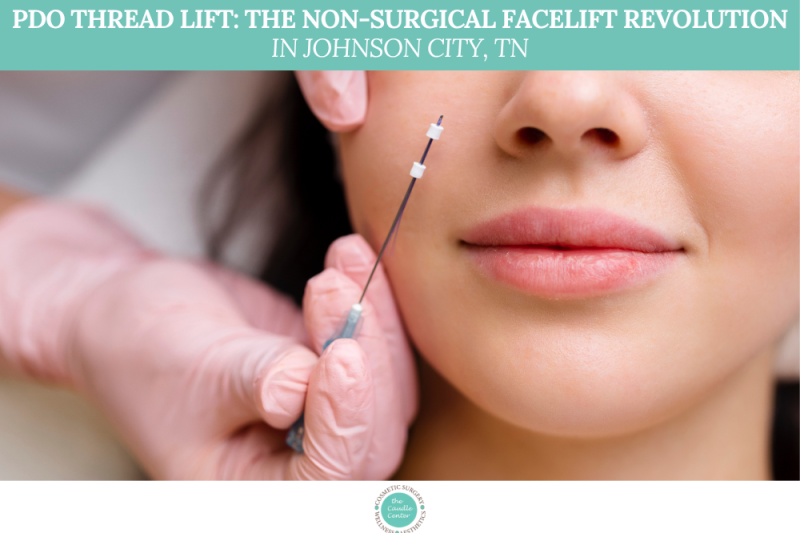 PDO Thread Lift The Non-Surgical Facelift Revolution in Johnson City, TN