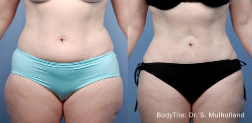 Bodytite Before After 1