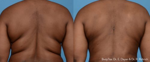 Bodytite Before After 2