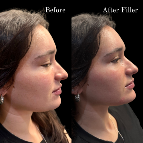 Chin Filler