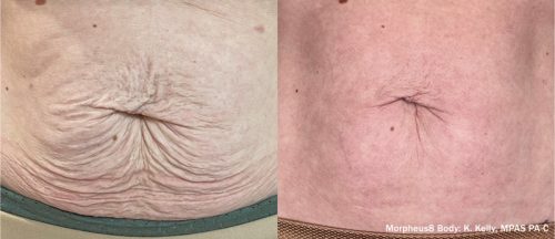 Morpheus8 Before After 1