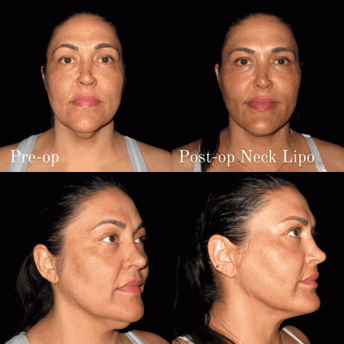 d-neck-lipo-1-copy