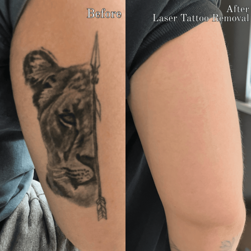 Before - After